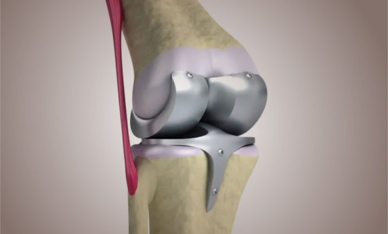 total knee replacement surgeries