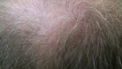 Hair Transplant