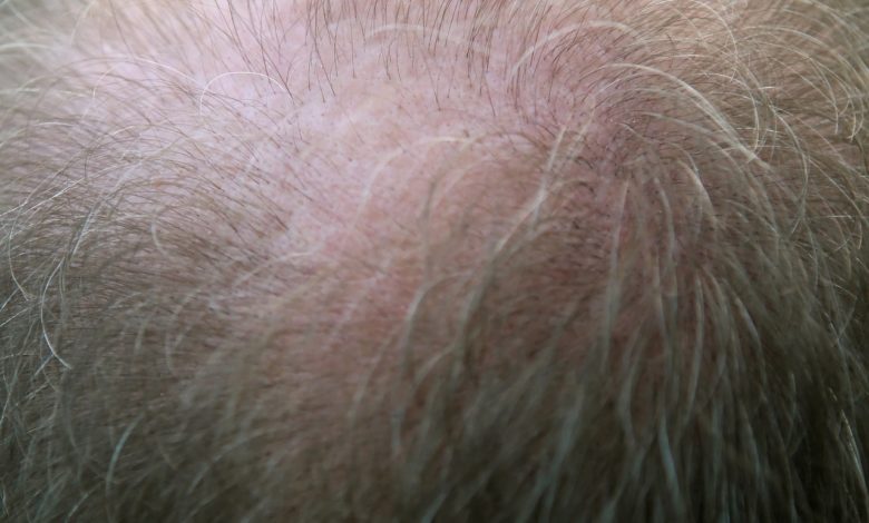 Hair Transplant